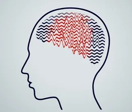 Can MS Cause Seizures